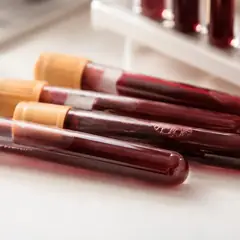 Covid long : 7 axes biologiques à discuter