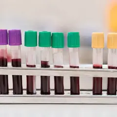 Biomarqueurs digestifs : au-delà de la calprotectine