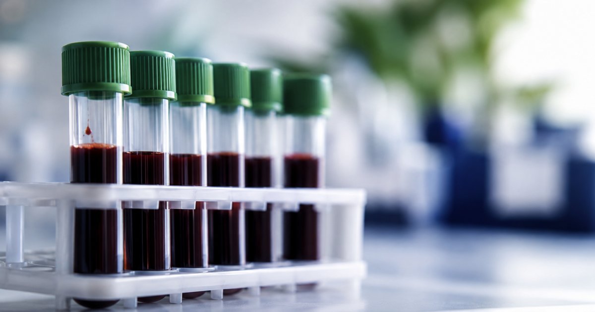 Biomarqueurs sanguins de l'EM/SFC : où en est la science ?