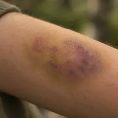 Bleus après infection : quand l'hémostase se dérègle