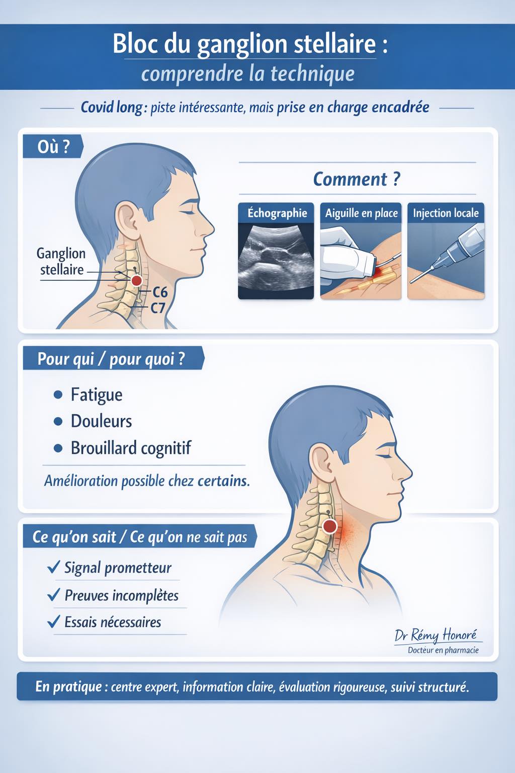 Infographie : Bloc du ganglion stellaire — comprendre la technique, pour qui, ce qu'on sait et ne sait pas