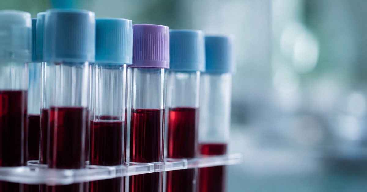 Illustration clinique d'un prélèvement sanguin en laboratoire, symbolisant l'analyse de biomarqueurs vasculaires du Covid long