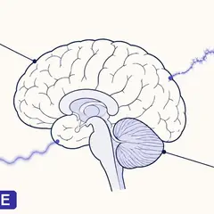 Brouillard mental : ce qui se passe dans votre cerveau